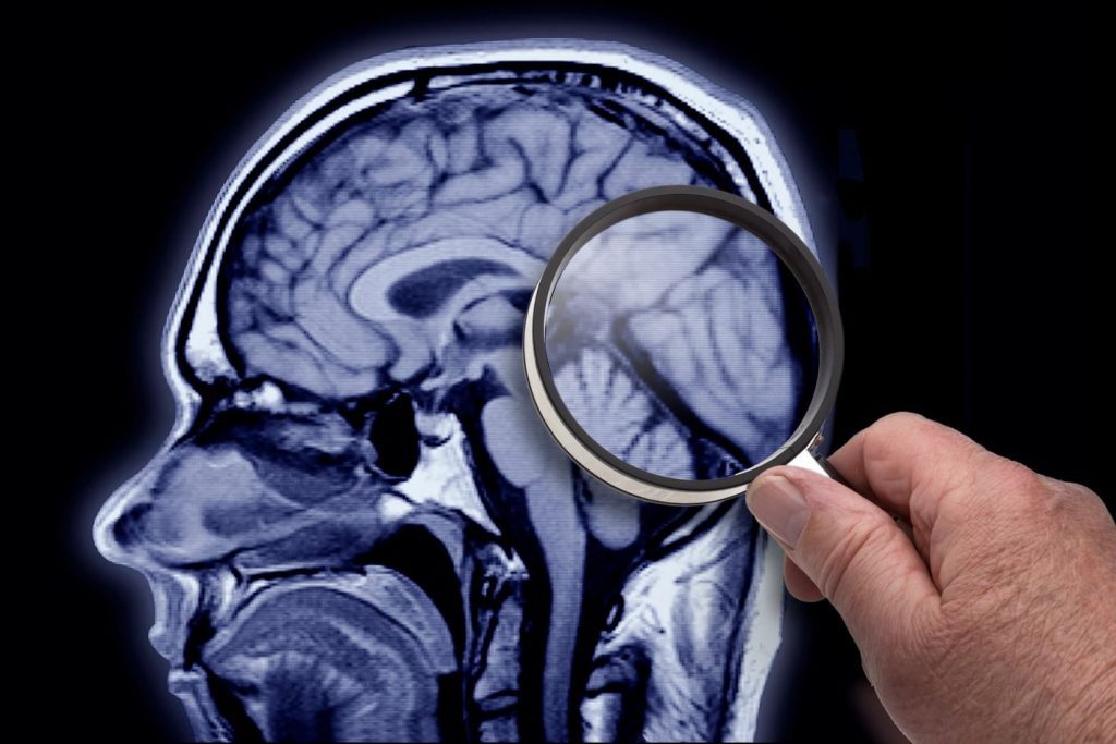 Alzheimer