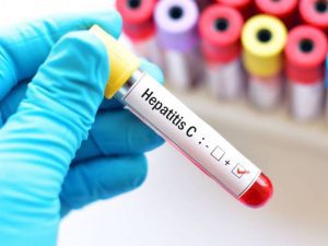 hepatitis c