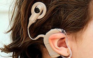 Implante Auditivo