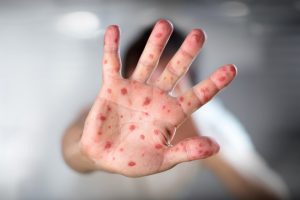viruela del mono mpox una mano