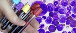 Leucemia Mieloide Crónica