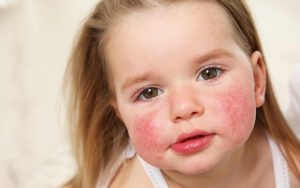 dermatitis atopica niña
