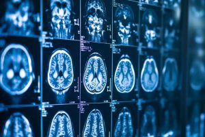 ai-mri-neurology-neuroscience