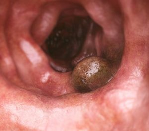 Cáncer de colon