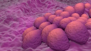 cancer de endometrio