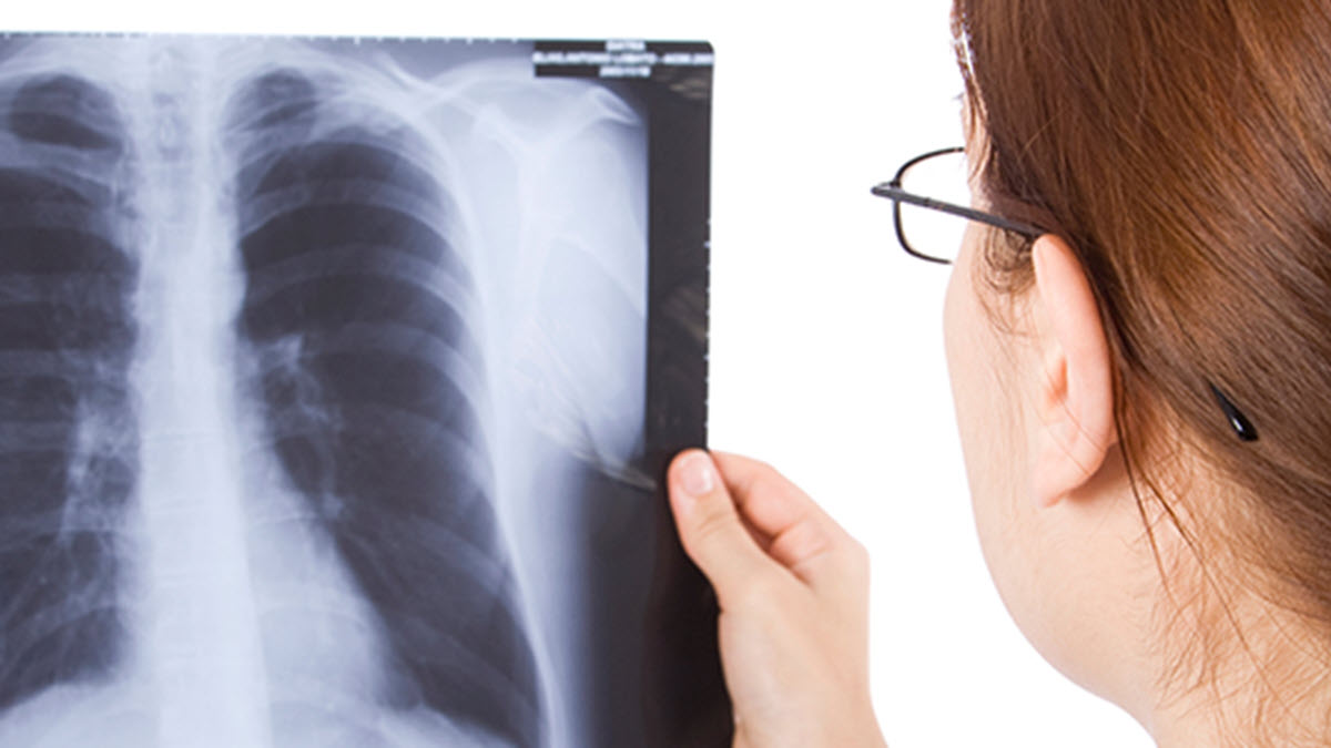 Tuberculosis