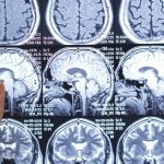 esclerosis múltiple