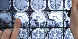 esclerosis múltiple