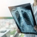 hipertensión arterial pulmonar