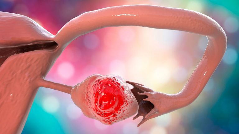 Cáncer de Ovario: hay más de 2.000 casos por año en Argentina