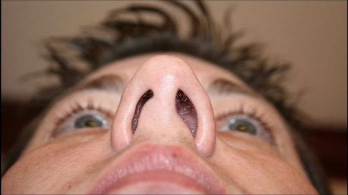 La poliposis nasal