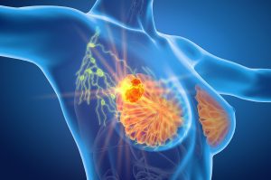Breast cancer with lymphatics, medically 3D illustration