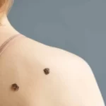 Los casos de melanoma