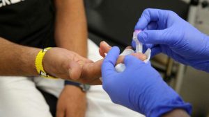 La hepatitis D es cancerígena