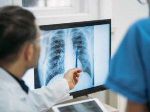 Fibrosis Pulmonar Idiopática