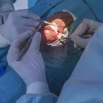 Reversión de la vasectomía