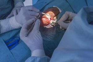 Reversión de la vasectomía