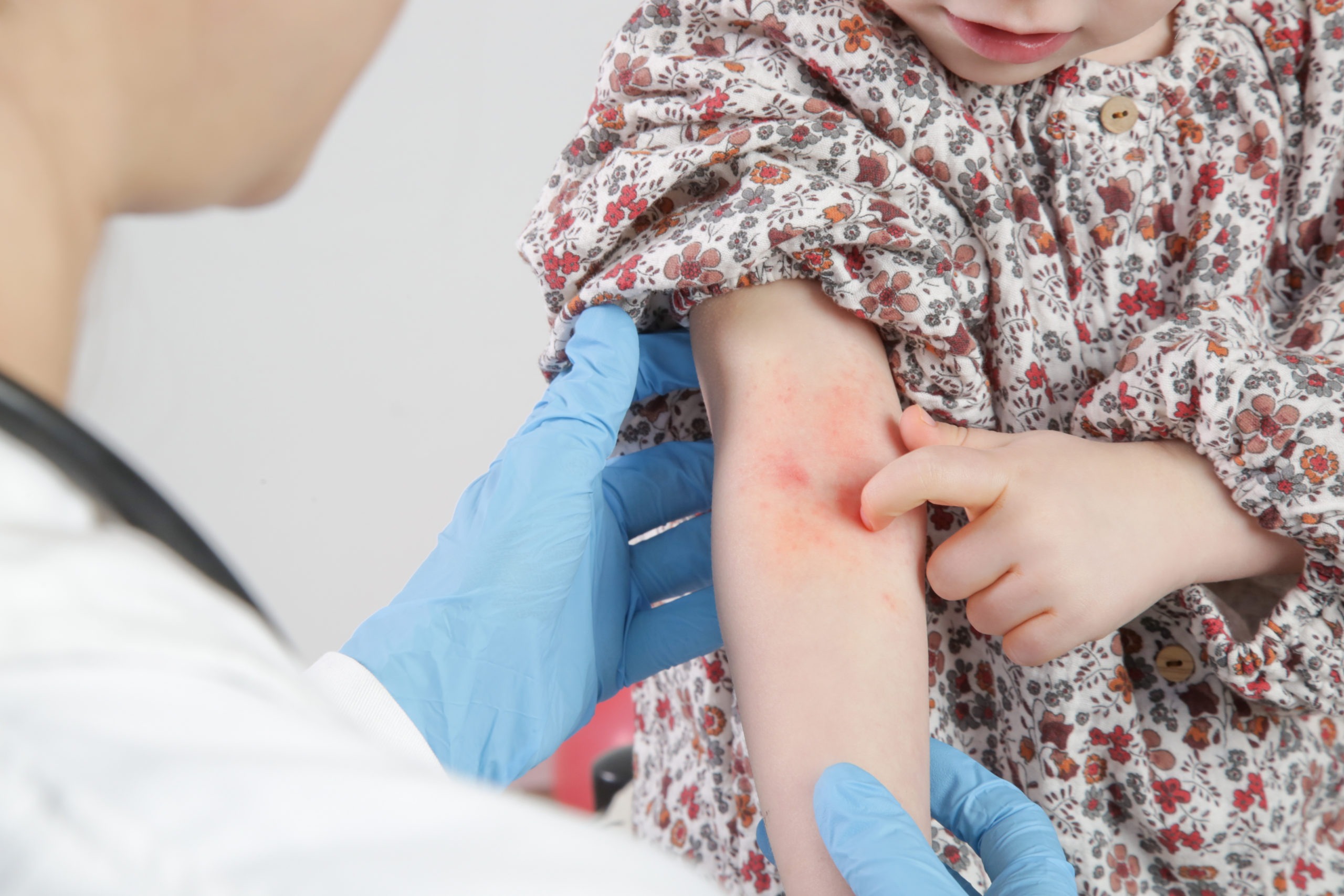 dermatitis atópica