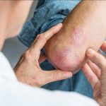 psoriasis