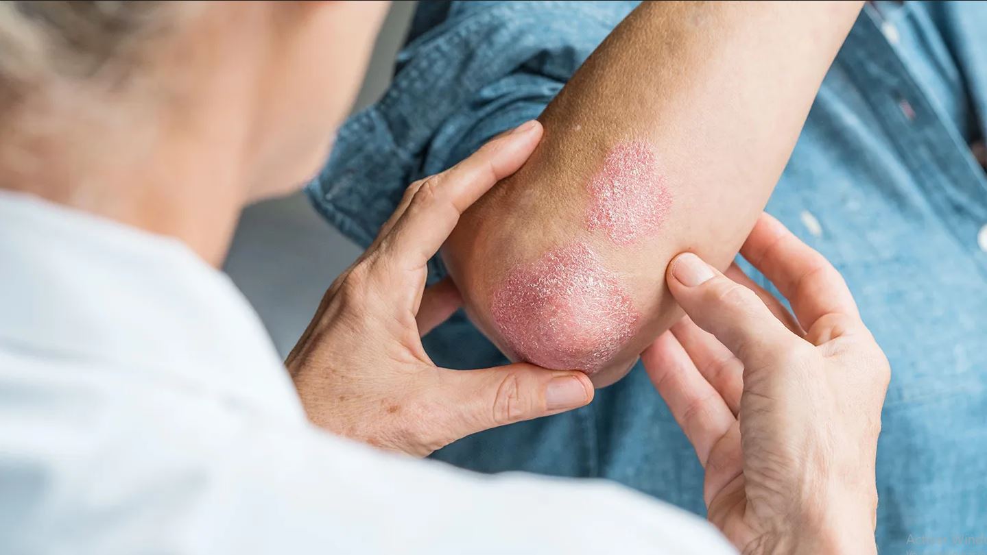 psoriasis