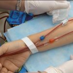 La Leucemia Mieloide Crónica