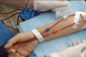 La Leucemia Mieloide Crónica