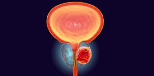 cancer-de-prostata