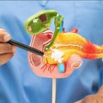 Cáncer de vías biliares