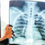 El cáncer de pulmón