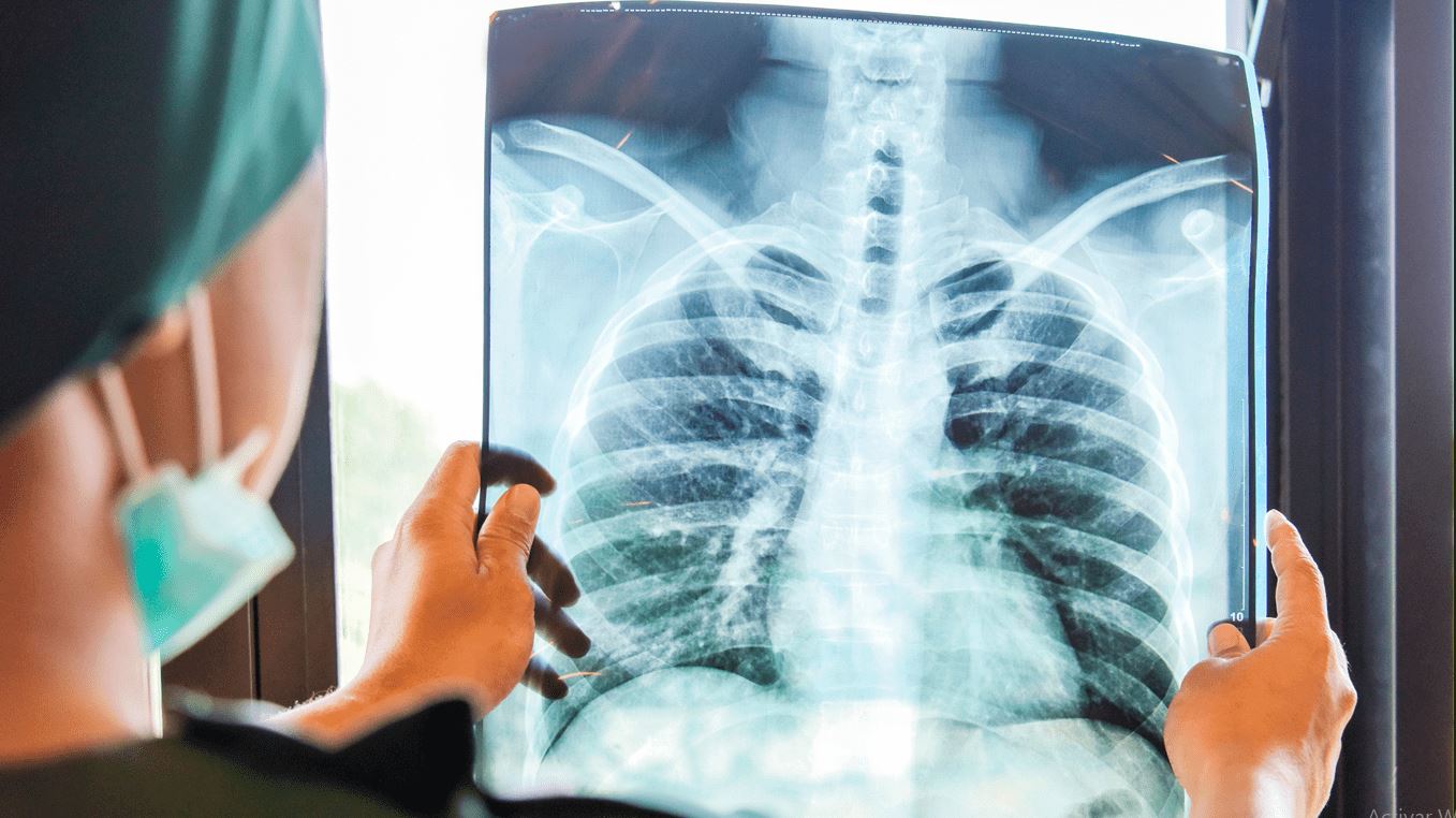 El cáncer de pulmón