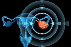 ovarian cancer de ovario