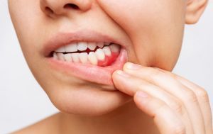 tratamiento-para-la-periodontitis