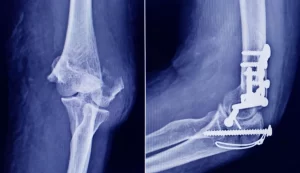 tornillo traumatologico