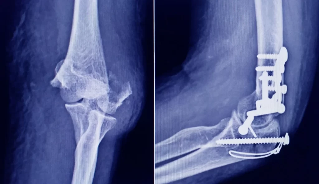 Los-tornillos-se-usan-en-cirugias-traumatologicas