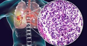 cáncer de pulmón de células pequeñas