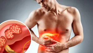 colangiocarcinoma avanzado