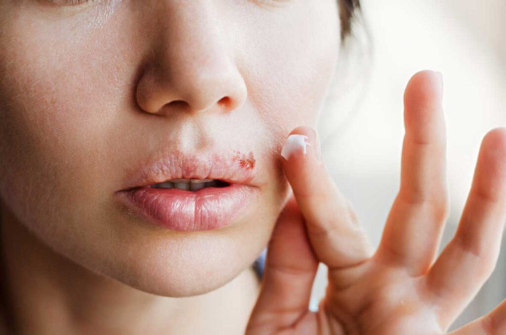 herpes-labial-infeccion-sintomas