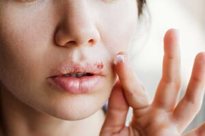 herpes-labial-infeccion-sintomas