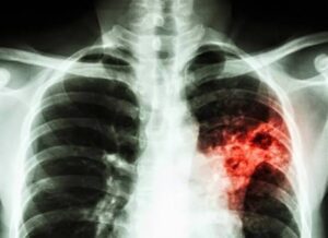 tuberculosis