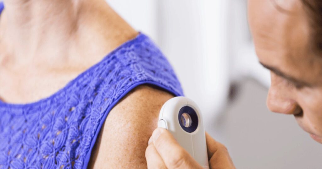melanoma avanzado