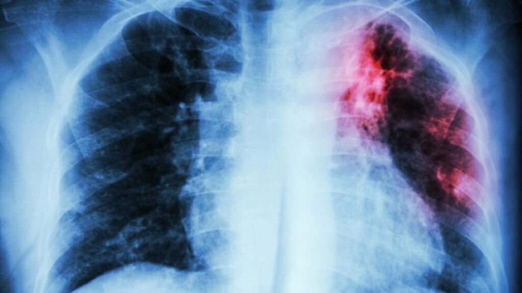 fibrosis pulmonar